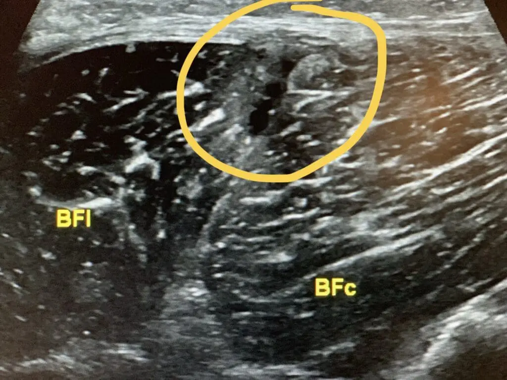 EPI Advanced - Rotura muscular tratada con EPI® - FOTO ENTRADA 3 BLOG