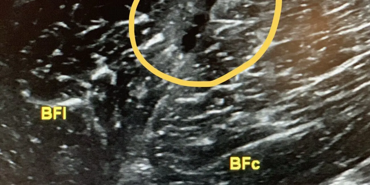 EPI Advanced - Rotura muscular tratada con EPI® - FOTO ENTRADA 3 BLOG